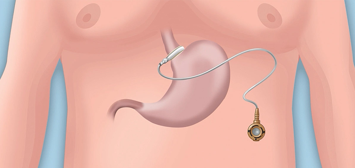 Gastric Sleeve Izmir Packages – All-Inclusive Surgery and Recovery Costs